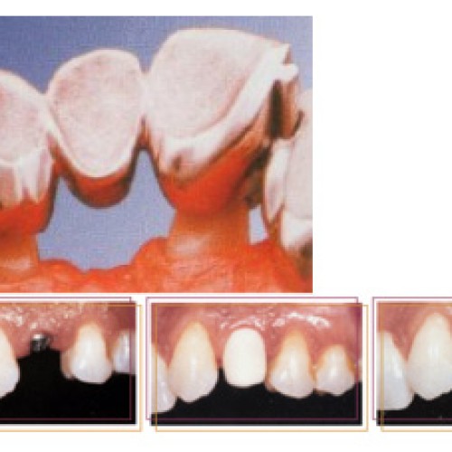 Implant prosthesis